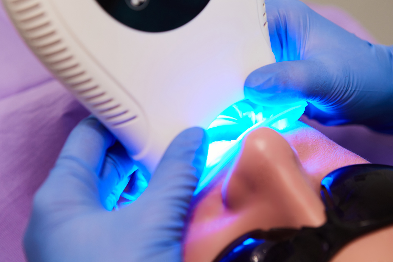 Teeth Whitening Procedure